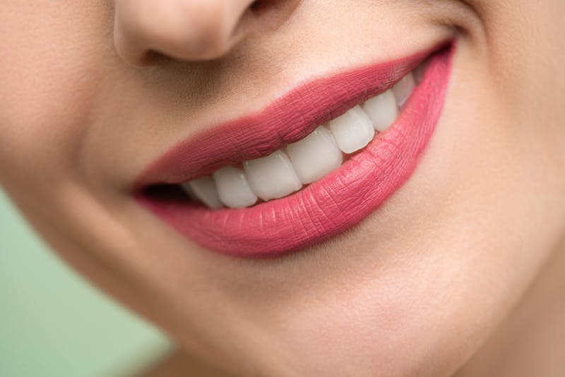After implant crown